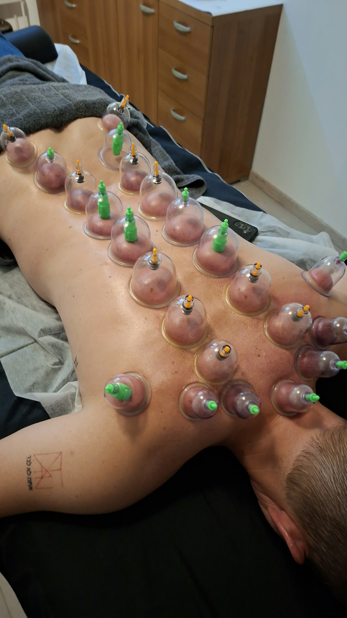 Cuppingmateriaal voor een behandeling